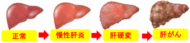 肝臓の絵、正常→慢性肝炎→肝硬変→肝がん